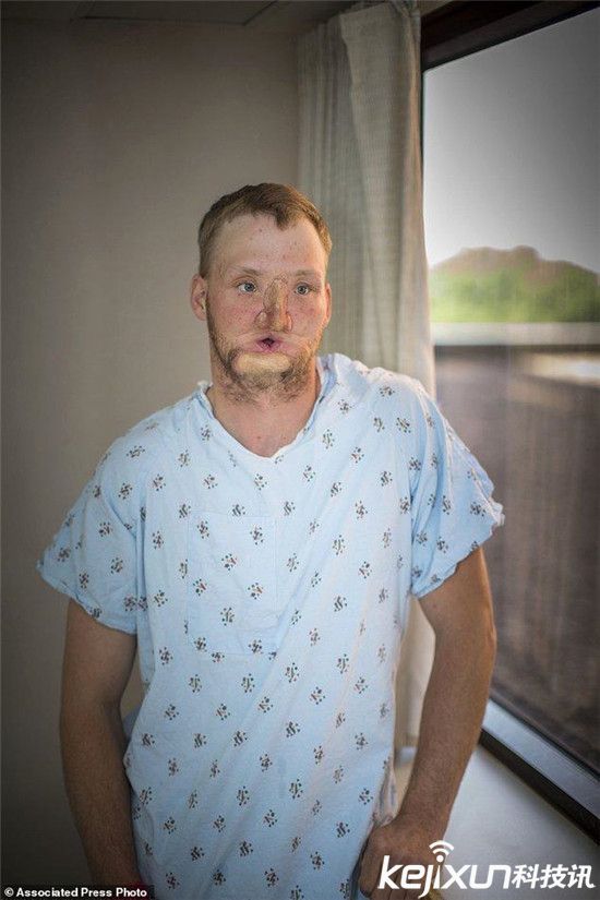 美国男子吞枪毁脸 10年后换脸获重生